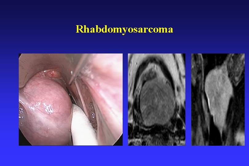 Rhabdomyosarcoma 