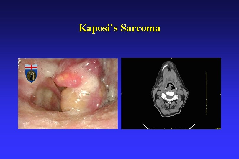 Kaposi’s Sarcoma 