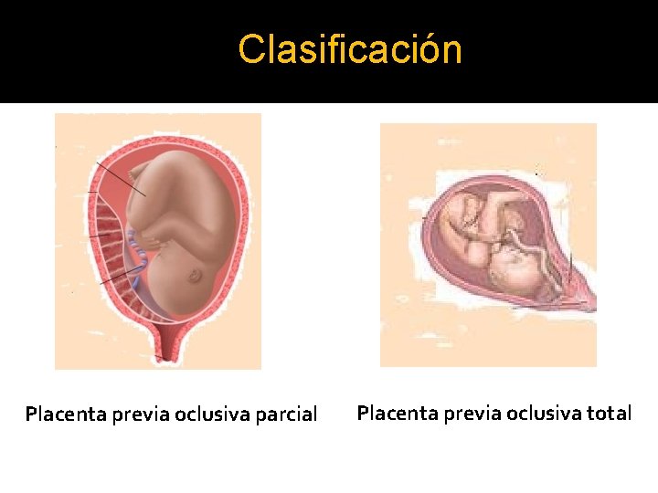Clasificación Placenta previa oclusiva parcial Placenta previa oclusiva total 
