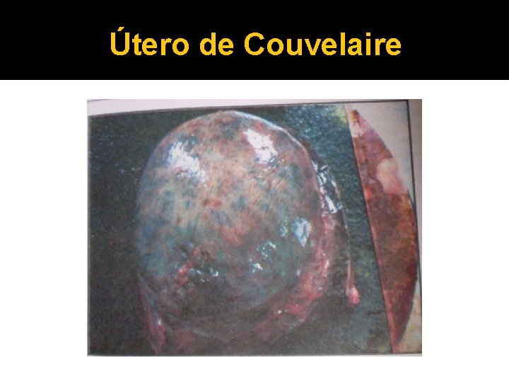 Útero de Couvelaire 