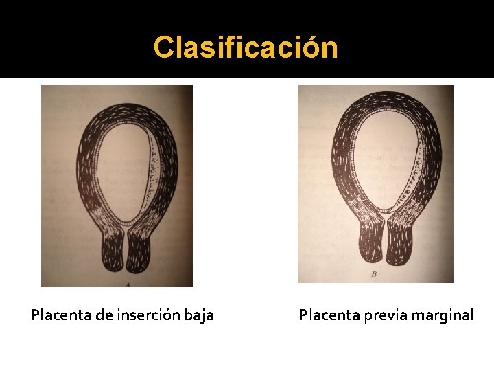 Clasificación Placenta de inserción baja Placenta previa marginal 