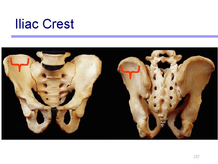 Iliac Crest 107 