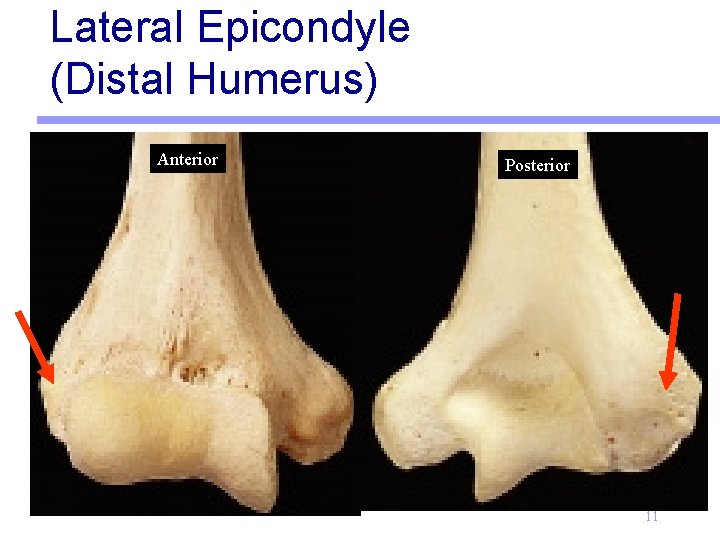 Lateral Epicondyle (Distal Humerus) Anterior Posterior 11 