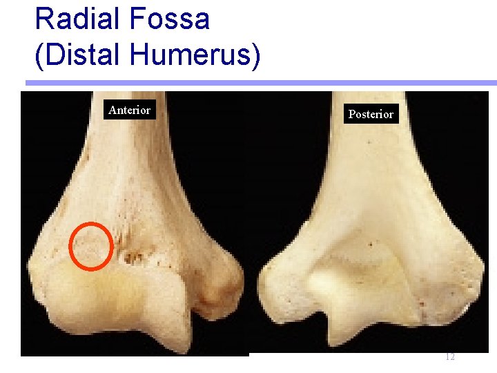Radial Fossa (Distal Humerus) Anterior Posterior 12 