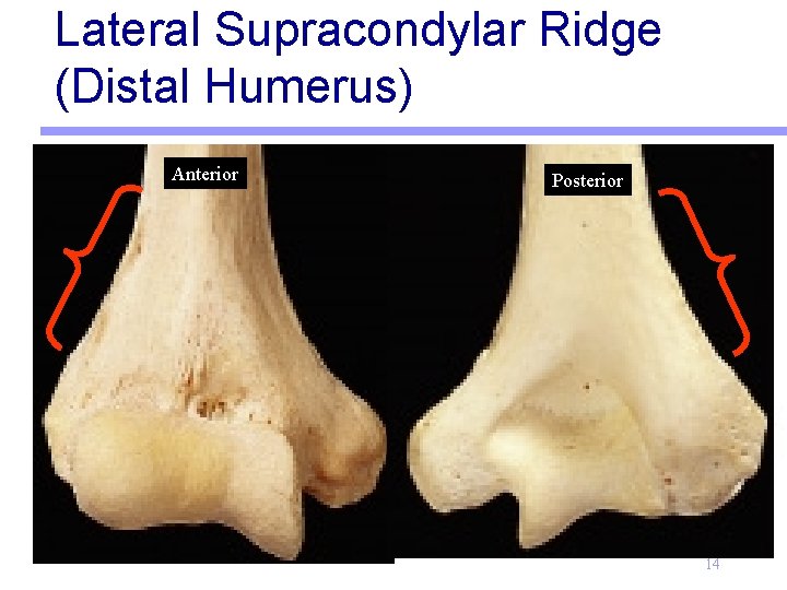 Lateral Supracondylar Ridge (Distal Humerus) Anterior Posterior 14 