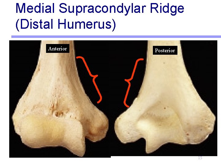 Medial Supracondylar Ridge (Distal Humerus) Anterior Posterior 15 
