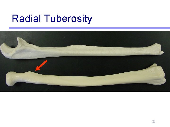 Radial Tuberosity 20 