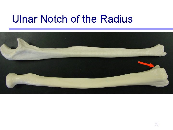 Ulnar Notch of the Radius 22 