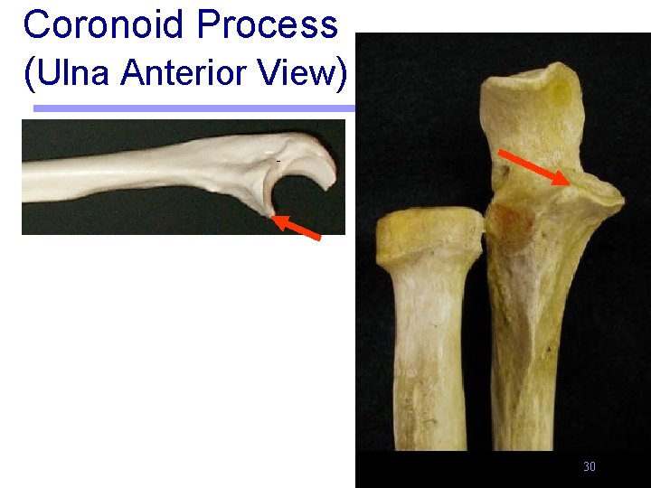 Coronoid Process (Ulna Anterior View) 30 