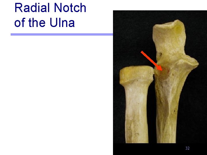 Radial Notch of the Ulna 32 