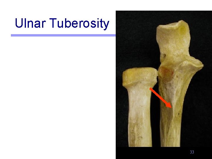 Ulnar Tuberosity 33 