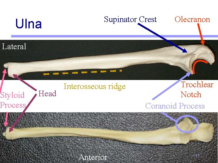 Ulna Supinator Crest Olecranon Lateral Styloid Process Head Interosseous ridge Anterior Trochlear Notch Coranoid