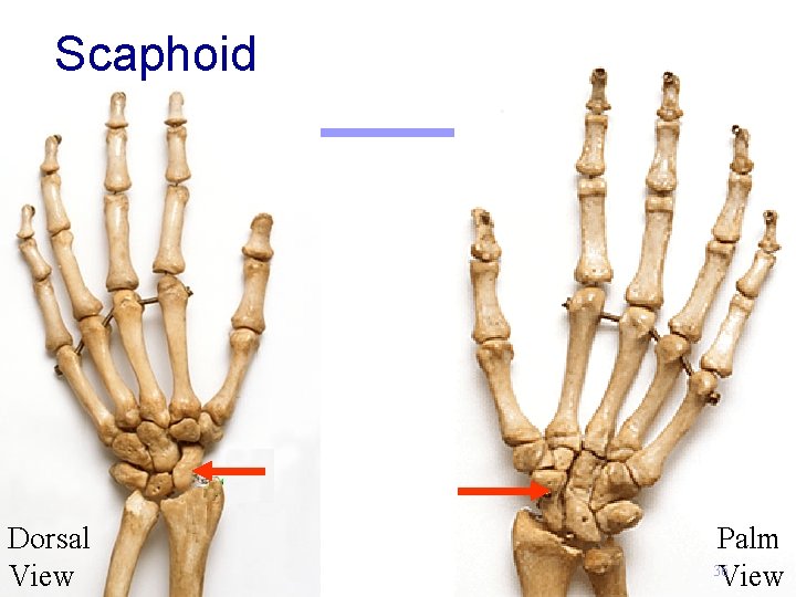 Scaphoid Dorsal View Palm 36 View 