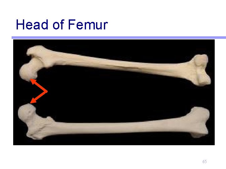 Head of Femur 65 