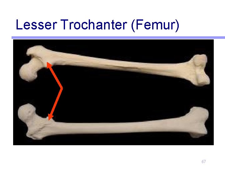 Lesser Trochanter (Femur) 67 
