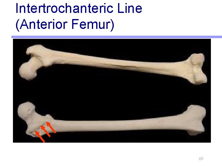 Intertrochanteric Line (Anterior Femur) 69 