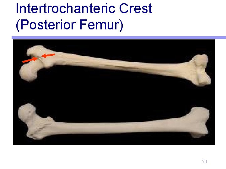 Intertrochanteric Crest (Posterior Femur) 70 