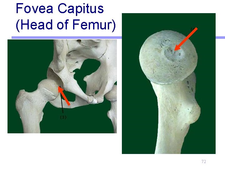 Fovea Capitus (Head of Femur) 72 