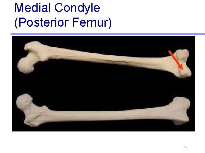 Medial Condyle (Posterior Femur) 73 