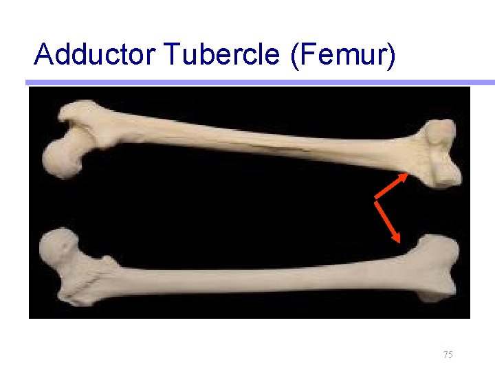 Adductor Tubercle (Femur) 75 