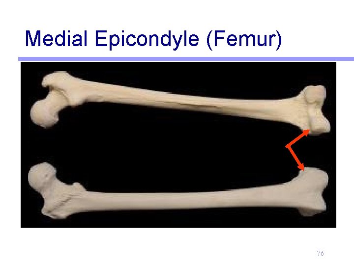 Medial Epicondyle (Femur) 76 