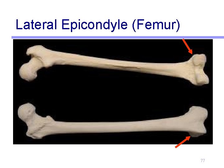 Lateral Epicondyle (Femur) 77 