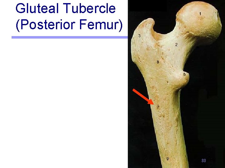Gluteal Tubercle (Posterior Femur) 80 