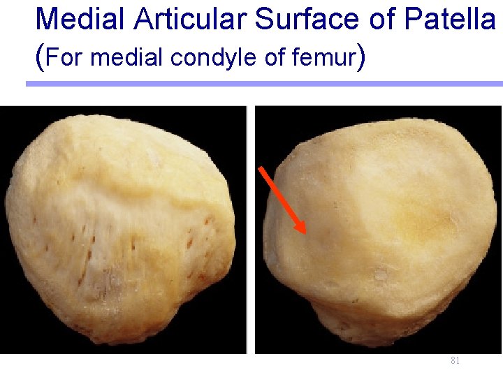 Medial Articular Surface of Patella (For medial condyle of femur) 81 