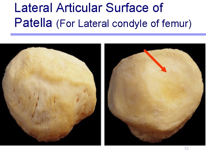Lateral Articular Surface of Patella (For Lateral condyle of femur) 82 