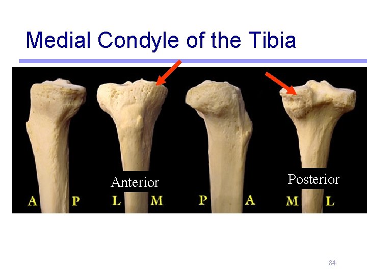 Medial Condyle of the Tibia Anterior Posterior 84 