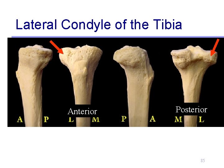 Lateral Condyle of the Tibia Anterior Posterior 85 