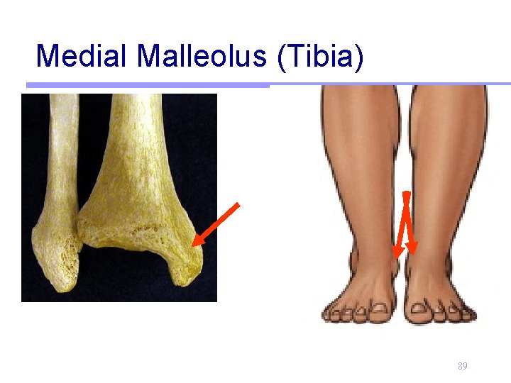 Medial Malleolus (Tibia) 89 