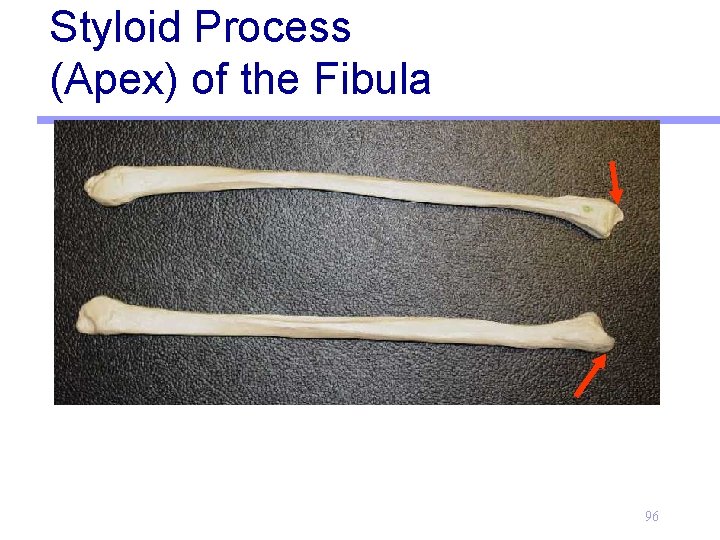 Styloid Process (Apex) of the Fibula 96 