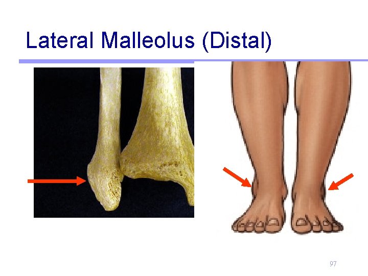 Lateral Malleolus (Distal) 97 