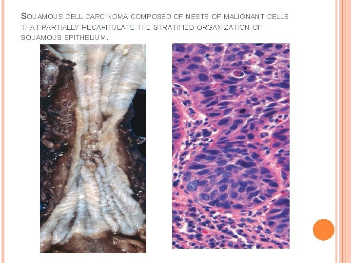 SQUAMOUS CELL CARCINOMA COMPOSED OF NESTS OF MALIGNANT CELLS THAT PARTIALLY RECAPITULATE THE STRATIFIED