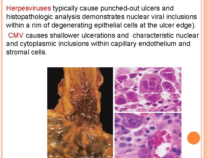Herpesviruses typically cause punched-out ulcers and histopathologic analysis demonstrates nuclear viral inclusions within a