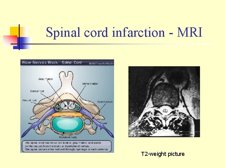 Spinal cord infarction - MRI T 2 -weight picture 