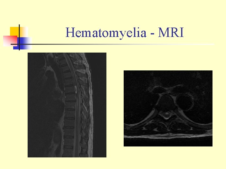Hematomyelia - MRI 