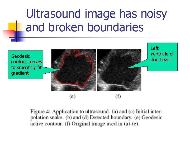 Ultrasound image has noisy and broken boundaries Geodesic contour moves to smoothly fit gradient