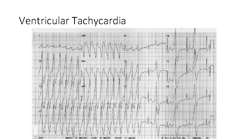 Ventricular Tachycardia 