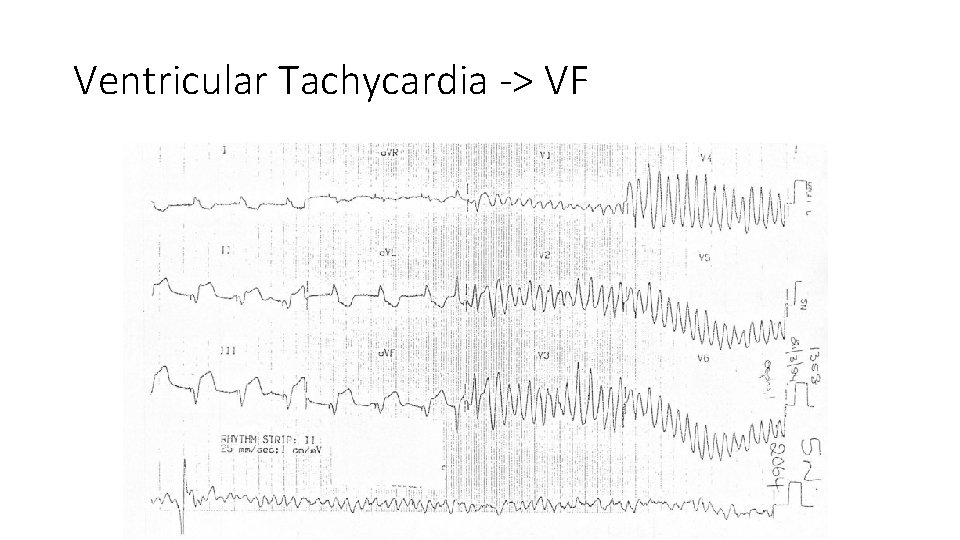 Ventricular Tachycardia -> VF 