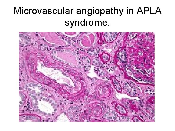 Microvascular angiopathy in APLA syndrome. 