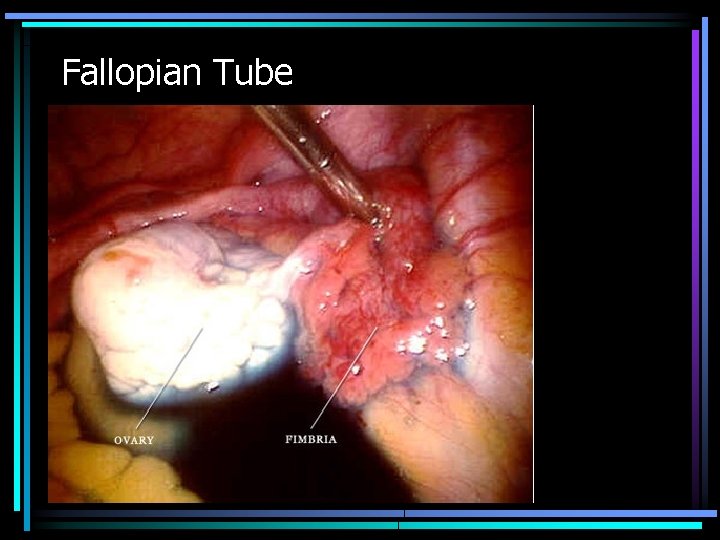 Fallopian Tube 