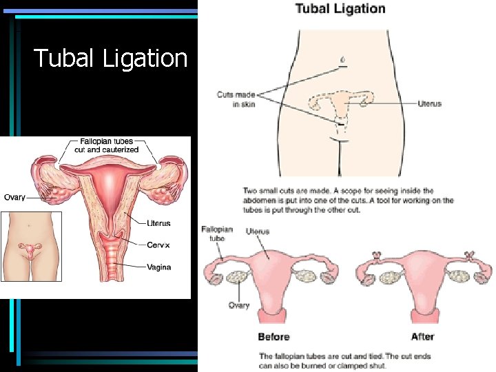 Tubal Ligation 