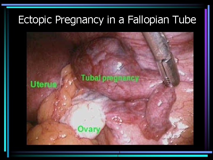 Ectopic Pregnancy in a Fallopian Tube 