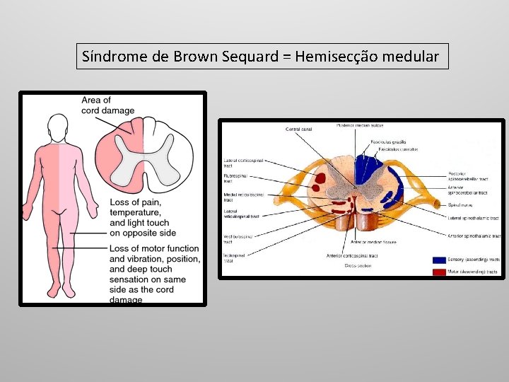 Síndrome de Brown Sequard = Hemisecção medular 