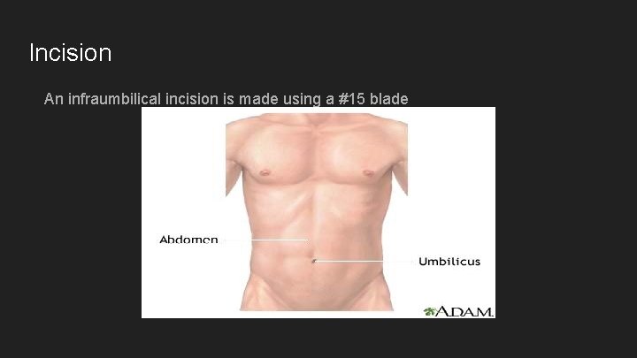 Incision An infraumbilical incision is made using a #15 blade 