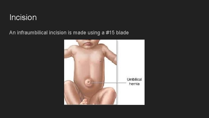 Incision An infraumbilical incision is made using a #15 blade 
