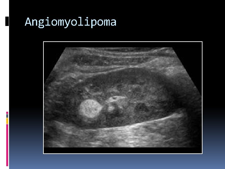 Angiomyolipoma 