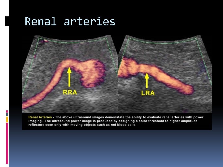 Renal arteries 